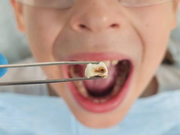 Best Knocked-Out Tooth (Avulsed Tooth) Treatment in Kimberly, WI